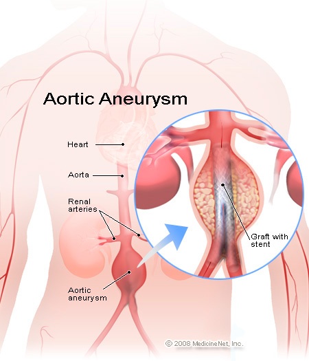 Aortic Aneurysm